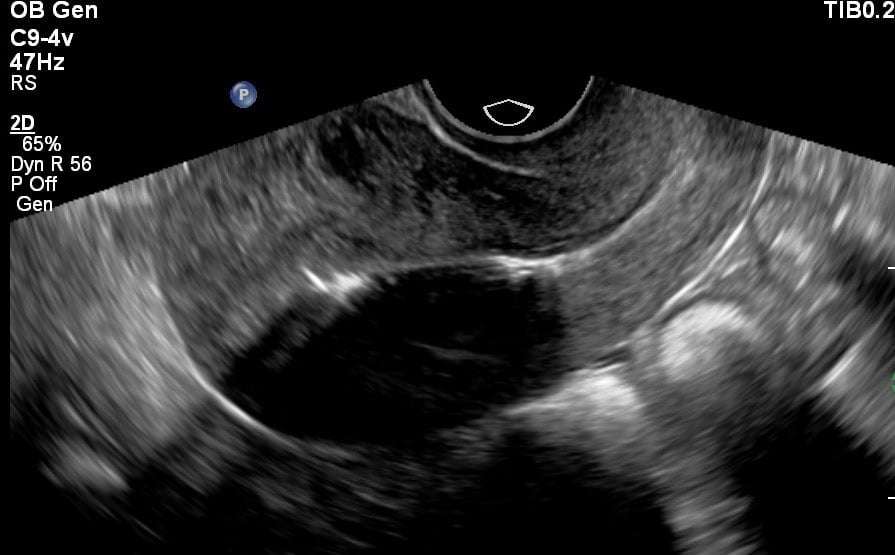 Anticonceptie echo in beeld