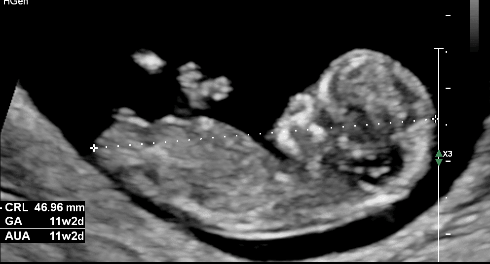 Voorbeeld van termijnecho 10-13 weken