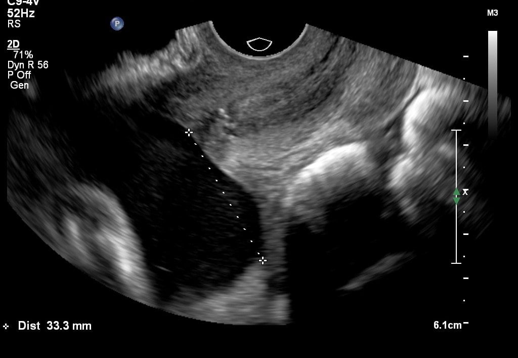 placenta lokalisatie echo