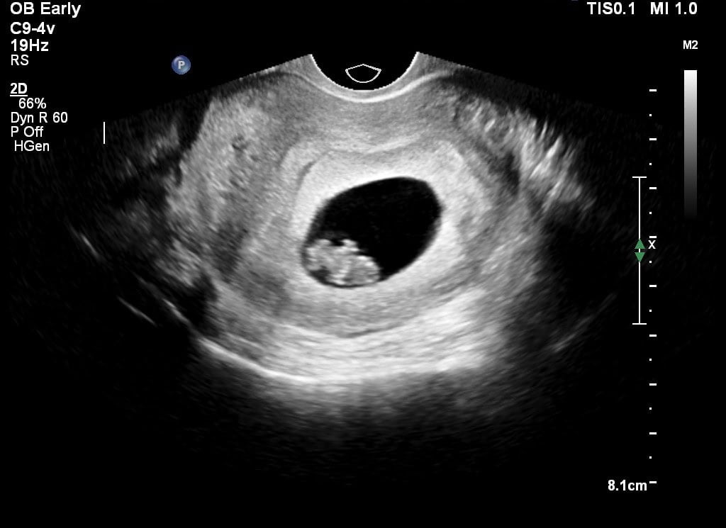Voorbeeld echo vroege zwangerschap